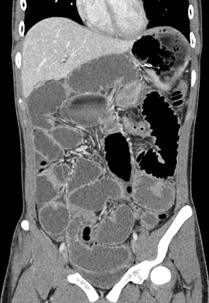 File:Adhesional small bowel obstruction (Radiopaedia 52107-57980 Coronal C+ portal venous phase 28).jpg