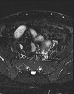 File:Adnexal multilocular cyst (O-RADS US 3- O-RADS MRI 3) (Radiopaedia 87426-103754 Axial T2 fat sat 5).jpg