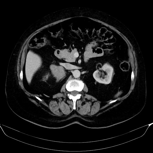 Adrenal cortical carcinoma (Radiopaedia 64017-72769 Axial C+ portal venous phase 26).jpg