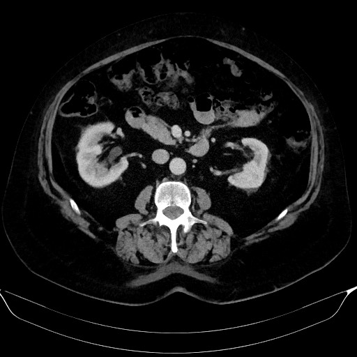File:Adrenal cortical carcinoma (Radiopaedia 64017-72769 Axial C+ portal venous phase 31).jpg