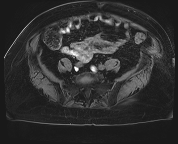 Adrenal cortical carcinoma (Radiopaedia 64017-72770 H 68).jpg