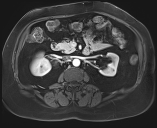 File:Adrenal cortical carcinoma (Radiopaedia 64017-72770 I 44).jpg