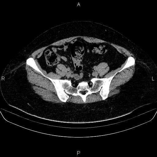 File:Adrenal cortical carcinoma (Radiopaedia 84882-100379 Axial non-contrast 72).jpg