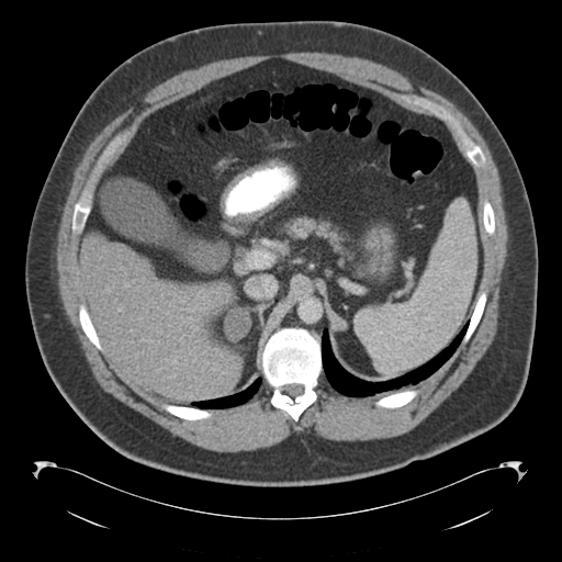 Adrenal cyst (Radiopaedia 45625-49776 Axial C+ portal venous phase 28).png