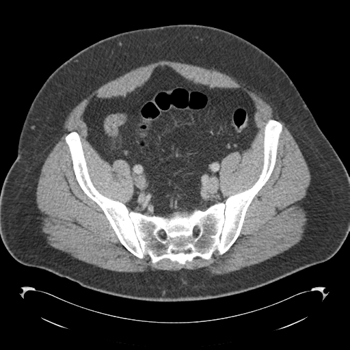 File:Adrenal cyst (Radiopaedia 45625-49776 Axial C+ portal venous phase 77).png