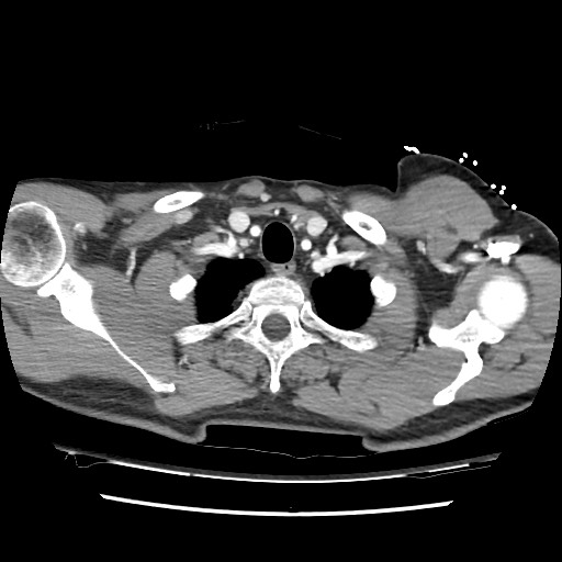 Adrenal gland trauma (Radiopaedia 81351-95078 Axial Dual bolus trauma C+ 13).jpg