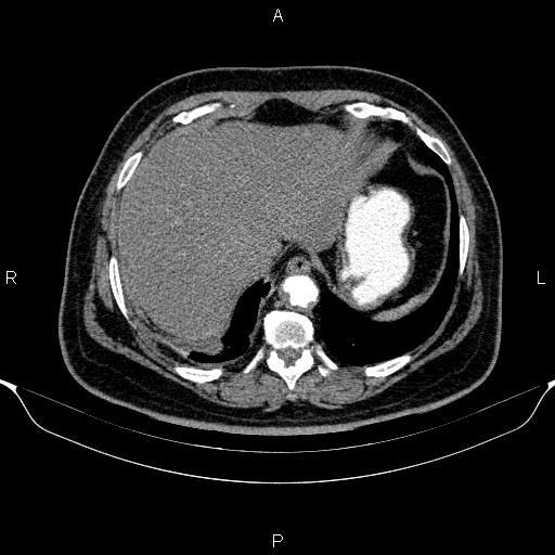 Adrenal hemorrhage (Radiopaedia 62622-70916 Axial C+ arterial phase 42).jpg