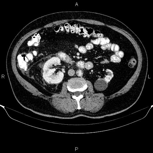 Adrenal hemorrhage (Radiopaedia 62622-70916 Axial C+ portal venous phase 91).jpg