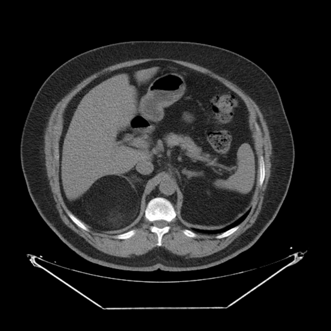 Adrenal myelolipoma (Radiopaedia 26278-26407 Axial non-contrast 17).jpg