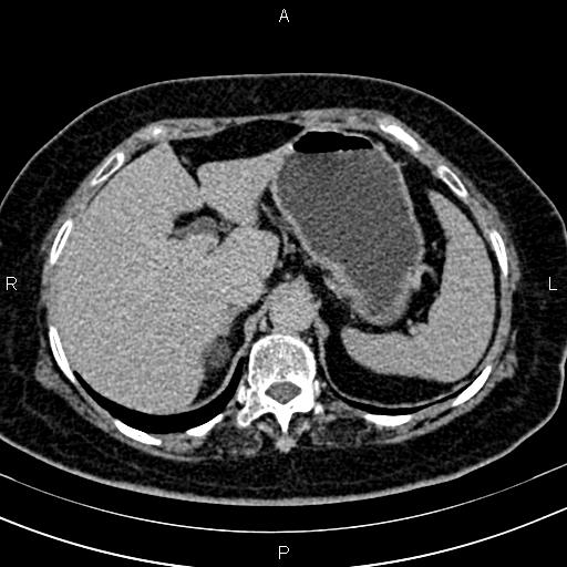 Adrenal myelolipoma (Radiopaedia 82742-96986 Axial renal excretory phase 29).jpg