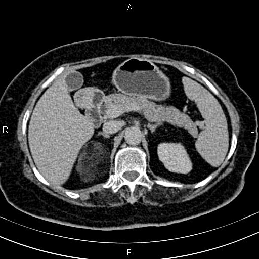 Adrenal myelolipoma (Radiopaedia 82742-96986 Axial renal excretory phase 41).jpg