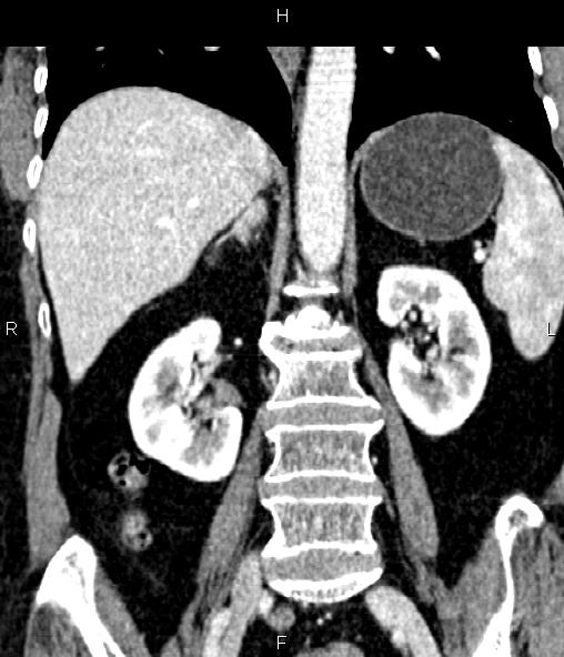 File:Adrenal myelolipoma (Radiopaedia 82742-96986 Coronal renal cortical phase 47).jpg