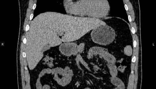 Adrenal myelolipoma (Radiopaedia 84321-99619 Coronal non-contrast 27).jpg