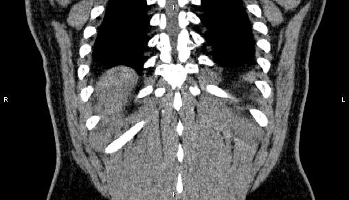 Adrenal myelolipoma (Radiopaedia 84321-99619 Coronal non-contrast 69).jpg