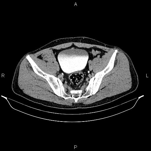Adrenal myelolipoma (Radiopaedia 87794-104246 Axial renal excretory phase 84).jpg