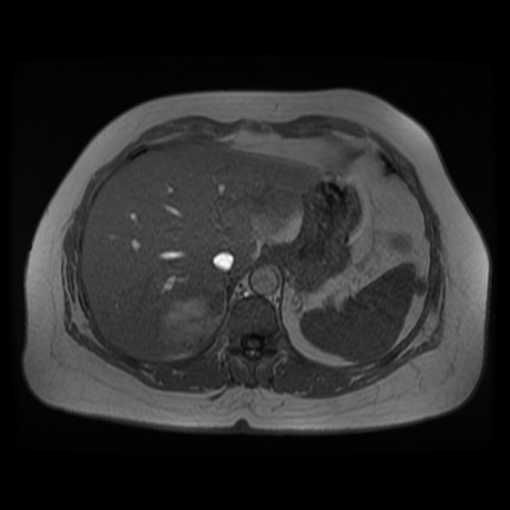 File:Adrenal myelolipoma - MRI (Radiopaedia 83249-97646 Axial T1-in phase 4).jpg