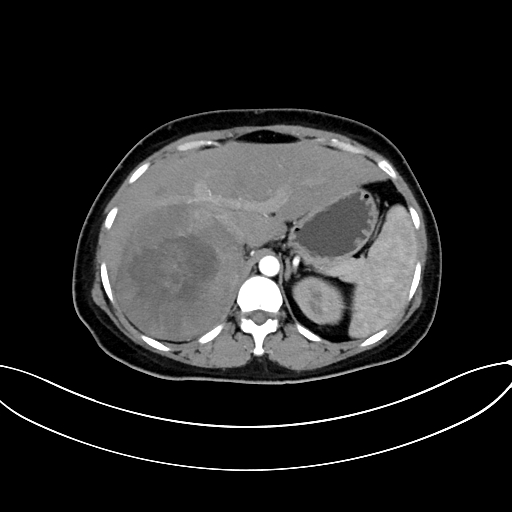 Adrenocortical carcinoma (Radiopaedia 87281-103569 Axial C+ arterial phase 25).jpg
