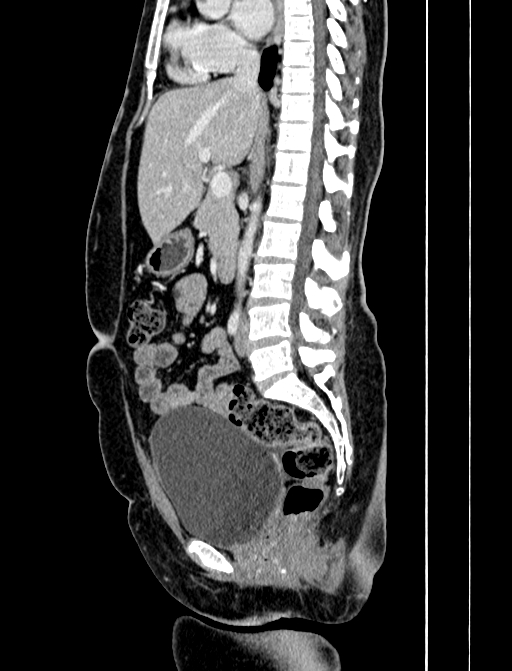 Adrenocortical carcinoma (Radiopaedia 87281-103569 Sagittal C+ portal venous phase 145).jpg