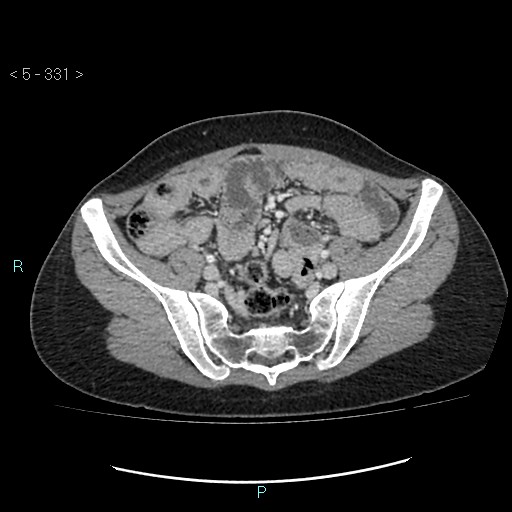 Adult transient intestinal intussusception (Radiopaedia 34853-36310 Axial C+ portal venous phase 80).jpg