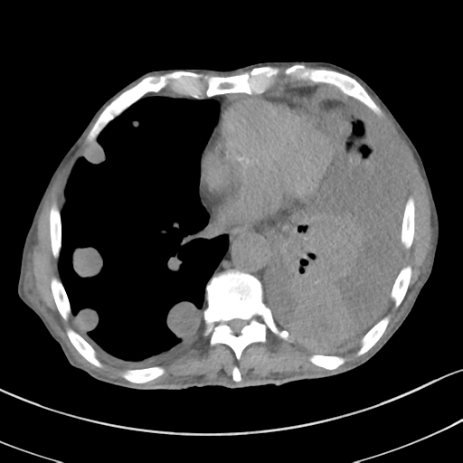 Advanced metastatic lung cancer (Radiopaedia 48910-53954 Axial non-contrast 41).png