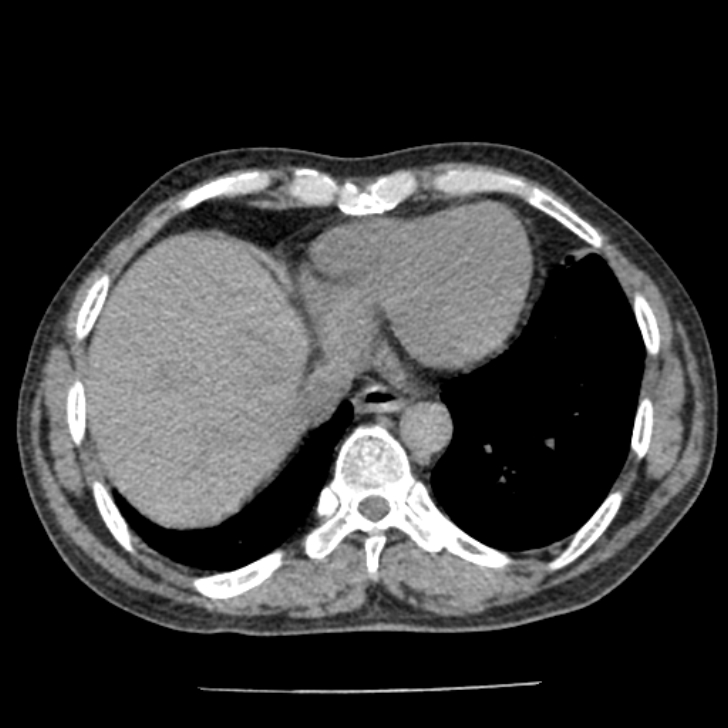 Airway foreign body in adult (Radiopaedia 85907-101779 Axial liver window 145).jpg