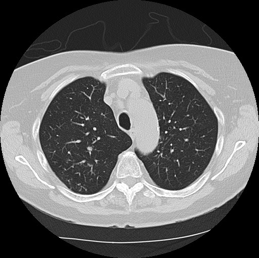Alpha-1-antitrypsin deficiency (Radiopaedia 72058-82557 Axial lung window 17).jpg