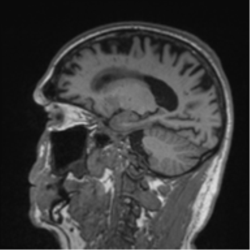 Alzheimer's disease- with Gerstmann syndrome and dressing apraxia (Radiopaedia 54882-61150 Sagittal T1 46).png