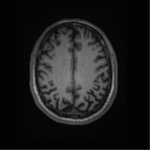 Alzheimer disease - probable (Radiopaedia 35334-36837 Axial T1 51).png