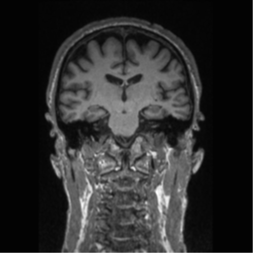 Alzheimer disease - probable (Radiopaedia 35334-36837 Coronal T1 43).png