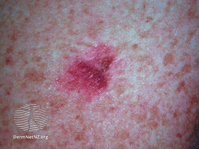 File:Amelanotic melanoma (DermNet NZ amelanotic-melanoma-020).jpg