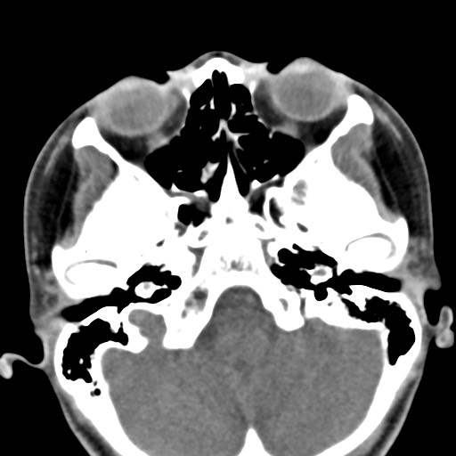 File:Ameloblastoma (Radiopaedia 26645-26793 Axial C+ delayed 37).jpg