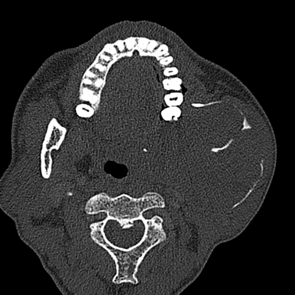Ameloblastoma (Radiopaedia 51921-57766 Axial bone window 91).jpg