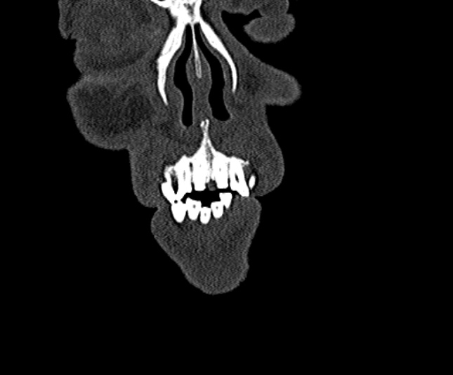 Ameloblastoma (Radiopaedia 51921-57766 Coronal bone window 11).jpg