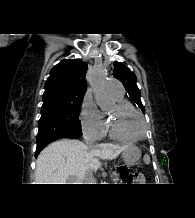 Amiodarone deposition in the liver (Radiopaedia 77587-89780 Coronal non-contrast 31).jpg