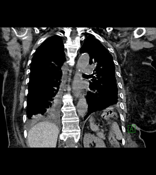 Amiodarone deposition in the liver (Radiopaedia 77587-89780 Coronal non-contrast 51).jpg