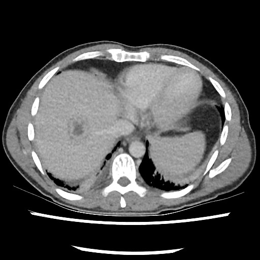 Amoebic liver abscesses (Radiopaedia 55536-62010 A 11).jpg