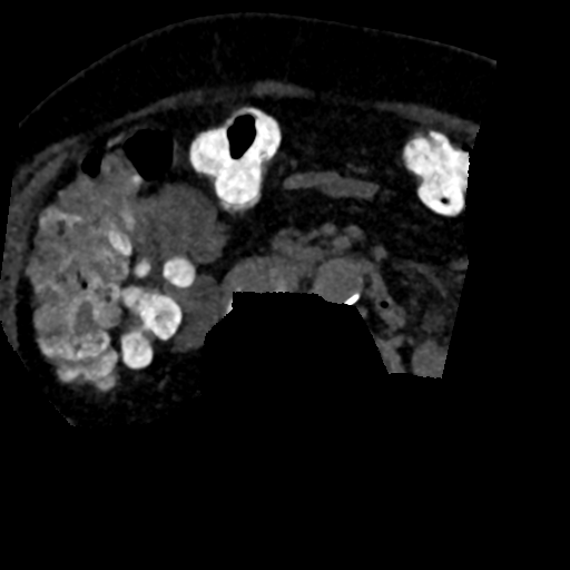 File:Ampullary adenocarcinoma (Radiopaedia 34013-35241 AXIAL MIPS 3-1.5 96).png