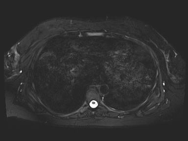 Ampullary adenocarcinoma (Radiopaedia 54765-61014 Axial T2 space-FS 2).jpg