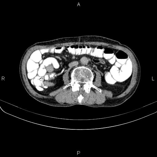 Ampullary adenocarcinoma (Radiopaedia 86093-102033 Axial C+ delayed 69).jpg