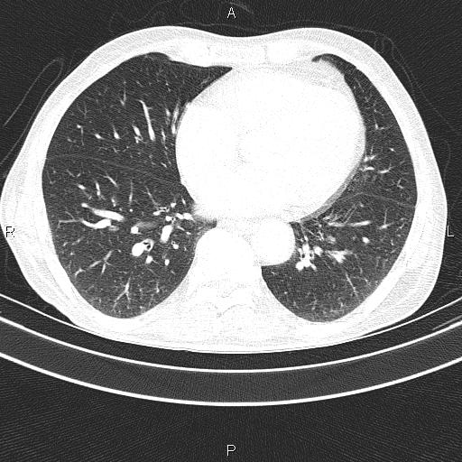 Ampullary adenocarcinoma (Radiopaedia 86093-102033 Axial lung window 40).jpg
