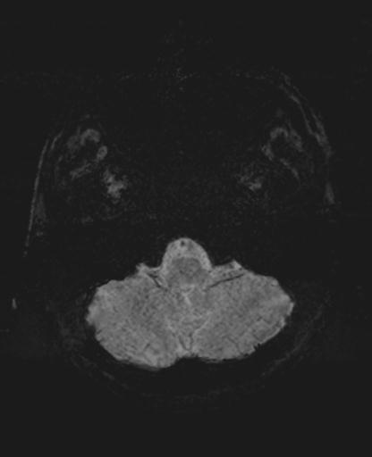 File:Amyloid angiopathy with inflammation (Radiopaedia 30360-31002 Axial SWI MIP 1).jpg