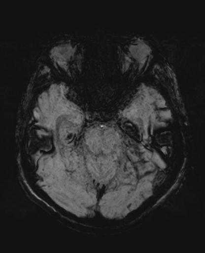 File:Amyloid angiopathy with inflammation (Radiopaedia 30360-31002 Axial SWI MIP 13).jpg