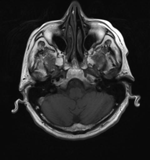 File:Amyloid angiopathy with inflammation (Radiopaedia 30360-31002 Axial T1 6).jpg