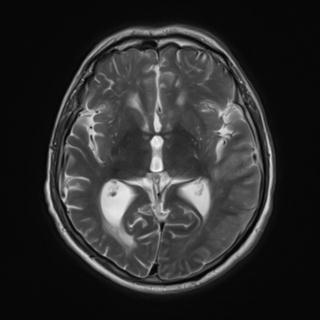 File:Amyloid angiopathy with inflammation (Radiopaedia 30360-31002 Axial T2 16).jpg