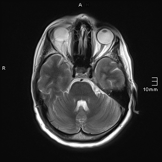 File:Amyotrophic lateral sclerosis (Radiopaedia 70821-81017 Axial T2 9).jpg
