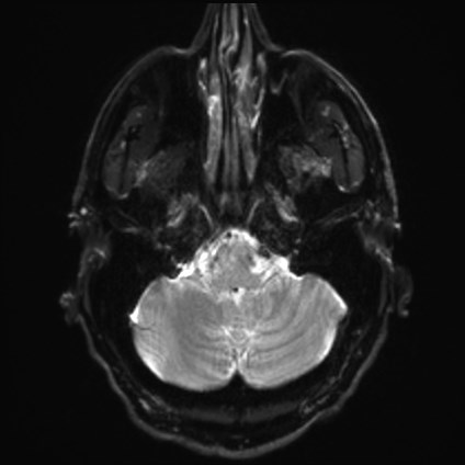 Amyotrophic lateral sclerosis (Radiopaedia 87352-103658 Axial DWI 4).jpg