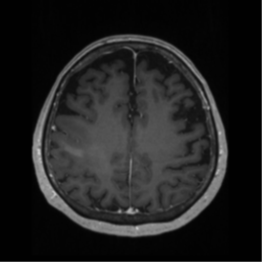 File:Anaplastic astrocytoma IDH wild-type (pseudoprogression) (Radiopaedia 42209-45276 Axial T1 C+ 104).png