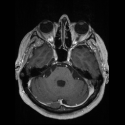 File:Anaplastic astrocytoma IDH wild-type (pseudoprogression) (Radiopaedia 42209-45276 Axial T1 C+ 48).png