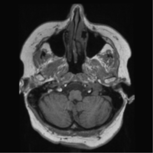 File:Anaplastic astrocytoma IDH wild-type (pseudoprogression) (Radiopaedia 42209-45278 Axial T1 34).png