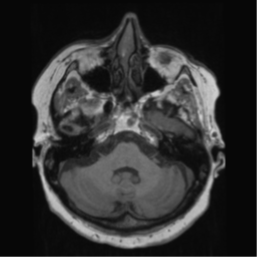 File:Anaplastic astrocytoma IDH wild-type (pseudoprogression) (Radiopaedia 42209-45278 Axial T1 45).png